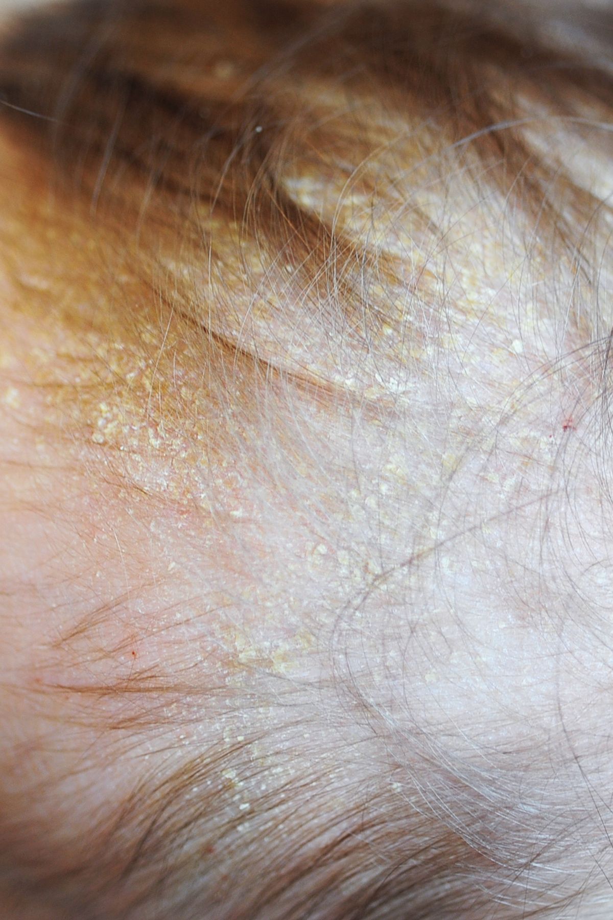 Close up of a baby's scalp with wispy brown hair and cradle cap.
