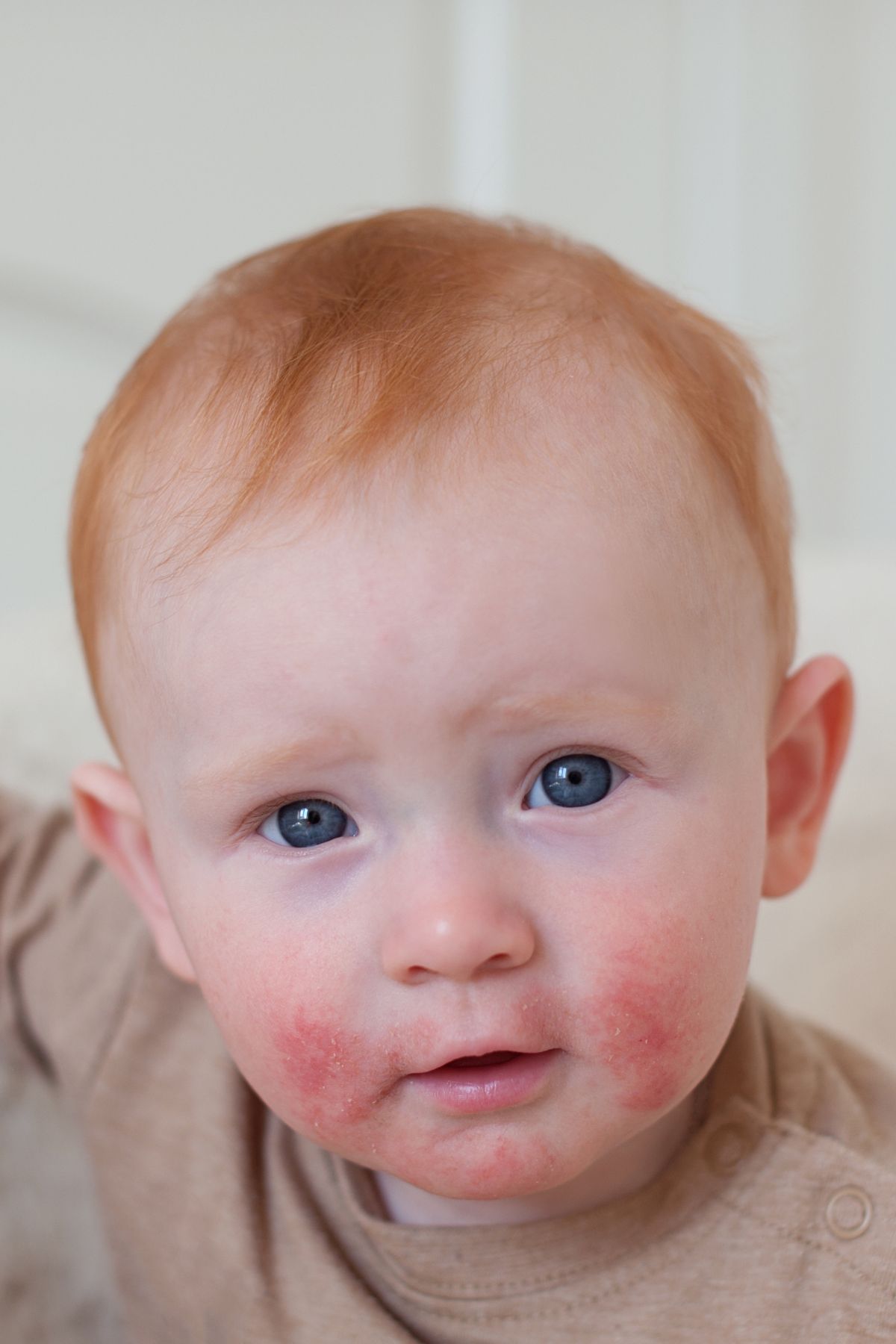 A redheaded toddler boy with an allergic rash around his mouth and cheeks.